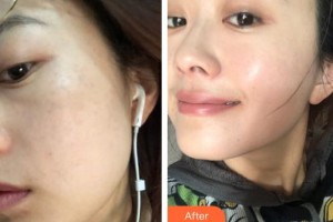 海口鵬愛醫(yī)療美容醫(yī)院任秀麗整形價(jià)格表附激光祛斑案例展示