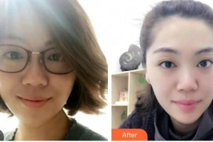 海口崔曦文醫(yī)療美容診所崔曦文整形價(jià)格表附光子嫩膚案例展示