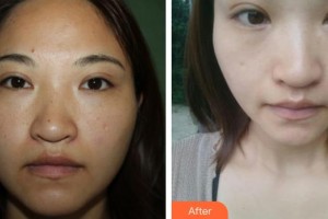 ?？谑械谒娜嗣襻t(yī)院眼科鐘羽麗整形價(jià)格表附清潔祛痘案例展示