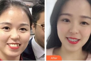 海口杭牙維信口腔門診部李娜住院醫(yī)師整形價(jià)格表附自鎖托槽矯正案例展示