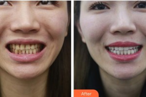 海口杭牙維信口腔門診部吳惠強(qiáng)整形價(jià)格表附美白貼片案例展示