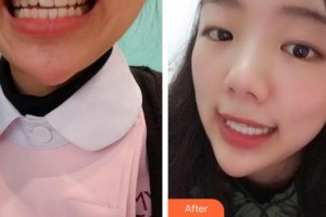 ?？诤佳谰S信口腔門診部樸光裕整形價(jià)格表附隱形托槽矯正案例展示