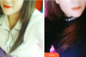 ?？隈R華祥口腔門診部馬華祥整形價(jià)格表附牙齒隱形矯正案例展示