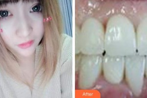 海口德恩口腔門診部喬磊整形價(jià)格表附超聲波潔牙案例展示