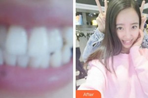 ?？诤佳谰S信口腔門診部楊惦山整形價(jià)格表附牙齒隱形矯正案例展示