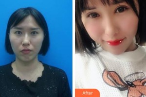 ?？诩t妝尚醫(yī)療美容門診部羅勇整形價(jià)格表附內(nèi)切祛眼袋案例展示