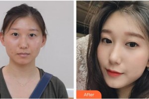 ?？诩t妝尚醫(yī)療美容門診部袁兆周整形價(jià)格表附切開雙眼皮案例展示