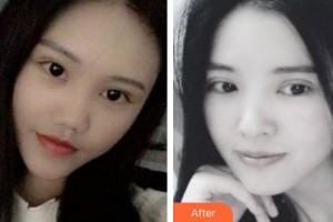 海口紅妝尚醫(yī)療美容門診部趙麗萍整形價(jià)格表附眼部綜合案例展示