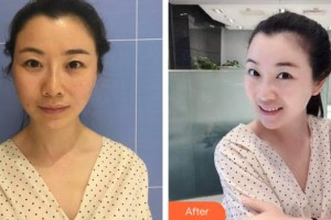 ?？诩t妝尚醫(yī)療美容門診部李楠整形價(jià)格表附埋線提升案例展示