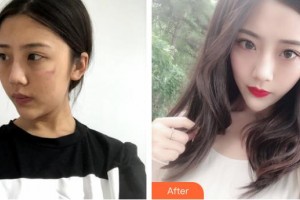 揚(yáng)州第一人民醫(yī)院整形美容科雷岳崇整形價(jià)格表附微創(chuàng)疤痕修復(fù)案例展示