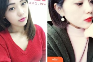 揚(yáng)州第一人民醫(yī)院整形美容科陳菊萍整形價(jià)格表附無針?biāo)獍咐故?>
</a>
<h3 class=