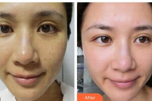 揚(yáng)州施爾美醫(yī)療美容醫(yī)院陳志輝整形價(jià)格表附微針美膚案例展示