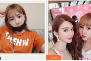 揚(yáng)州麗致醫(yī)療美容門診部付林杰整形價(jià)格表附水氧活膚案例展示