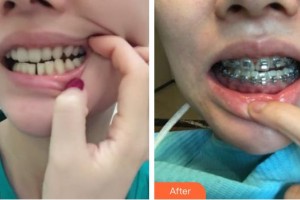 揚(yáng)州艾菲斯醫(yī)療美容門診部韋新東整形價(jià)格表附牙齒隱形矯正案例展示