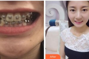 揚(yáng)州施爾美醫(yī)療美容醫(yī)院石增玲整形價(jià)格表附金屬托槽矯正案例展示