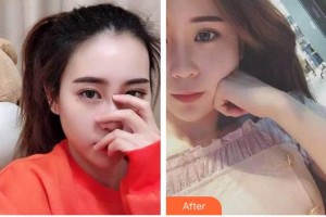 揚(yáng)州貝恩口腔醫(yī)院車蓓整形價(jià)格表附牙齒隱形矯正案例展示