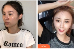 荊州迪亞羅蘭醫(yī)療美容門診部李軍整形價格表附去痘印痘坑案例展示