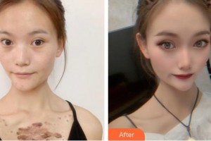 荊州市第二人民醫(yī)院整形激光美容中心林海濤整形價(jià)格表附微創(chuàng)疤痕修復(fù)案例展示