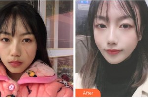 荊州市第一人民醫(yī)院整形美容科張俊整形價格表附微創(chuàng)疤痕修復(fù)案例展示