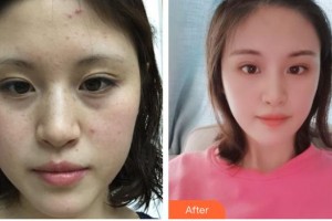 荊州市中心醫(yī)院整形美容外科田方興 整形價格表附激光祛斑案例展示