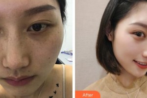 荊州名韓醫(yī)療美容診所曾佳整形價格表附激光祛斑案例展示