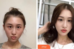 荊州中愛醫(yī)療整形美容門診部李林整形價格表附去痘印痘坑案例展示