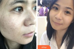 荊州市中心醫(yī)院整形美容外科文漢東 整形價格表附激光祛斑案例展示