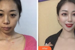 荊州市中心醫(yī)院整形美容外科王圣早整形價格表附微創(chuàng)疤痕修復(fù)案例展示