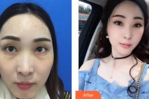 荊州華美整形美容醫(yī)院沈沛整形價格表附激光去眼袋案例展示