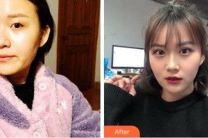 荊州華夏眼科醫(yī)院羅中華整形價(jià)格表附切開(kāi)雙眼皮案例展示