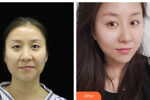 荊州市婦幼保健院眼科何維銘整形價格表附眼部修復(fù)案例展示