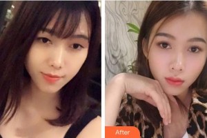 荊州愛爾眼科醫(yī)院凃惠芳整形價(jià)格表附眼部綜合案例展示