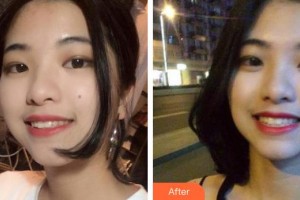 荊州公安縣楚星口腔門診胡歡歡整形價格表附牙齒隱形矯正案例展示