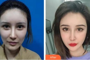 黃岡皇氏醫(yī)療美容醫(yī)院王海平整形價(jià)格表附埋線提升案例展示