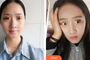 黃岡皇氏醫(yī)療美容醫(yī)院丁毅整形價(jià)格表附熱拉提案例展示