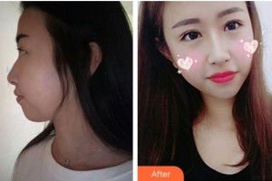 黃岡愛(ài)爾眼科醫(yī)院張麗整形價(jià)格表附眼部綜合案例展示