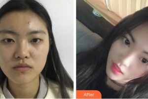 黃岡愛(ài)爾眼科醫(yī)院高小峰整形價(jià)格表附切開(kāi)雙眼皮案例展示