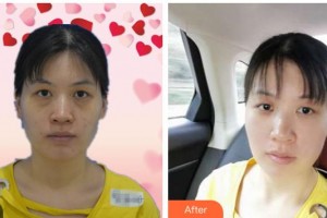 黃岡愛(ài)爾眼科醫(yī)院馮桂鳳整形價(jià)格表附激光去眼袋案例展示