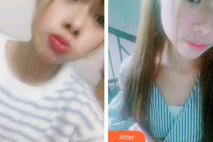 黃岡皓雅口腔醫(yī)院夏宣童整形價(jià)格表附根管調(diào)節(jié)案例展示