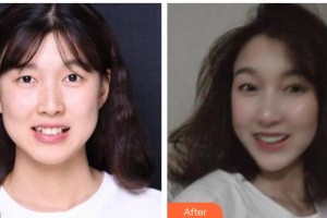 黃岡皓雅口腔醫(yī)院涂玲整形價(jià)格表附牙齒隱形矯正案例展示