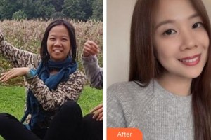 黃岡皓雅口腔醫(yī)院聶典整形價(jià)格表附牙齒隱形矯正案例展示