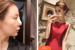 隨州市中心醫(yī)院醫(yī)學(xué)美容科鄧茜整形價(jià)格表附墊鼻基底案例展示