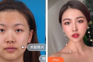 隨州真愛整形美容醫(yī)院高成整形價(jià)格表附鼻部綜合案例展示