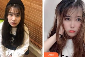 隨州愛爾眼科醫(yī)院阮海晶整形價(jià)格表附切開雙眼皮案例展示