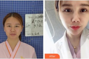 隨州愛爾眼科醫(yī)院唐亮整形價(jià)格表附眼部綜合案例展示