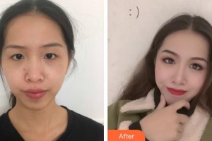 隨州愛爾眼科醫(yī)院江霞整形價(jià)格表附眼部綜合案例展示