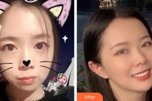 隨州泰康拜博口腔醫(yī)院劉輝整形價(jià)格表附金屬托槽矯正案例展示