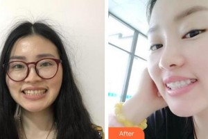 隨州泰康拜博口腔醫(yī)院羅永紅整形價(jià)格表附金屬托槽矯正案例展示