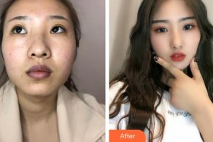 咸寧安美醫(yī)療美容門診部李愛林整形價(jià)格表附埋線提升案例展示