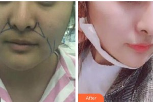 咸寧韓美醫(yī)療美容醫(yī)院段家海整形價(jià)格表附埋線提升案例展示